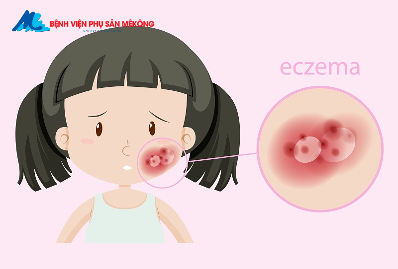 Vắc xin sởi quai bị rubella