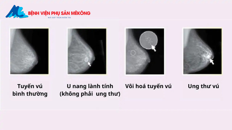 Chụp nhũ ảnh