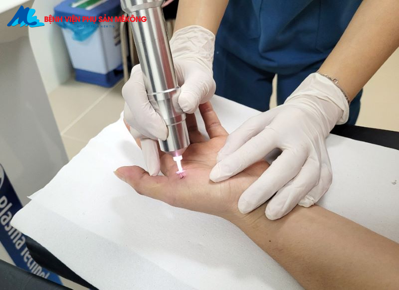 chiếu tia plasma sau sinh