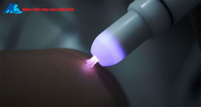 chiếu tia plasma sau sinh